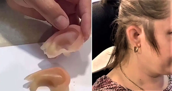 В Медицинском центре КГМА впервые изготовили протез ушной раковины или искусственное ухо двум пациентам