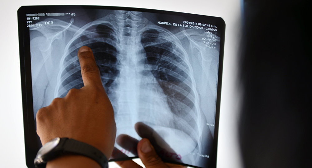 Врач смотрит рентген снимок легкого больного туберкулезом. Архивное фото