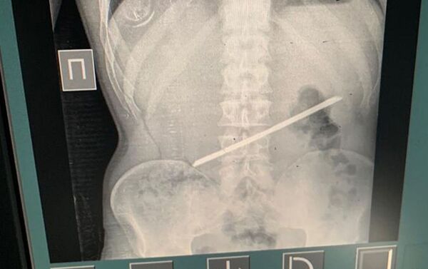 В Алматы врачи извлекли из желудка пациента 25-сантиметровую арматуру - Sputnik Кыргызстан