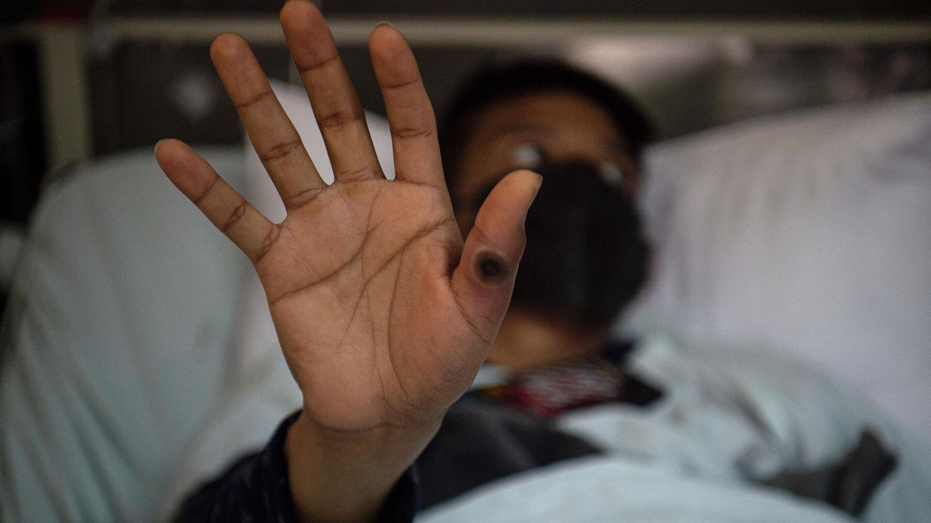 Пациент больницы показывает свою руку с раной обезьяньей оспы - Sputnik Кыргызстан, 1920, 20.09.2022