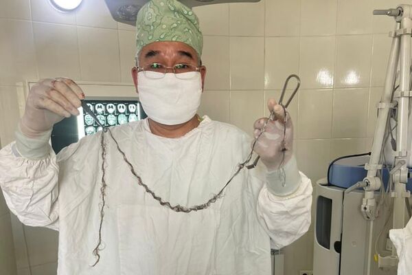 Эне жана баланы коргоо улуттук борборунун нейрохирургия бөлүмүндө мээге уникалдуу операция жасалды - Sputnik Кыргызстан