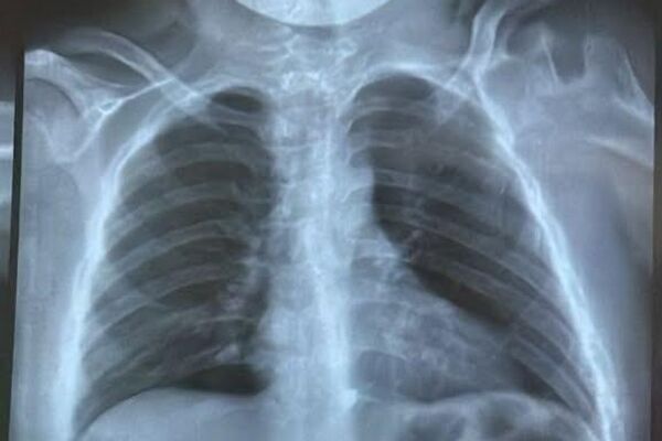 В Бишкеке 15-летний подросток проглотил кость 3,5 × 4 сантиметра, ее достали операционным путем - Sputnik Кыргызстан