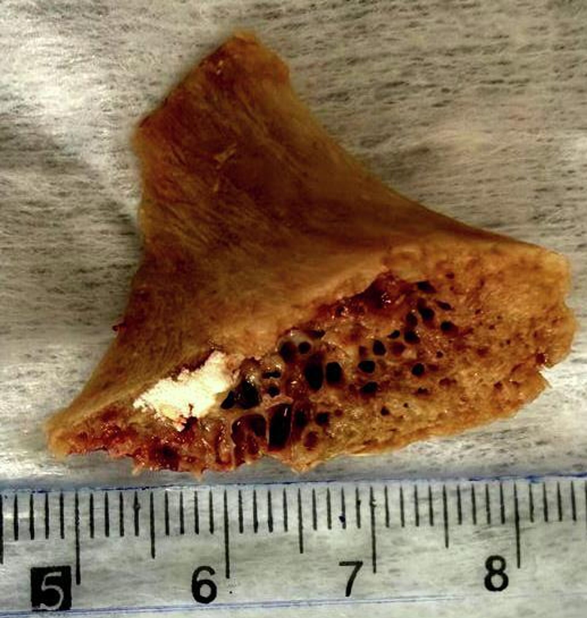 В Бишкеке 15-летний проглотил крупную кость - Sputnik Кыргызстан, 1920, 01.04.2026