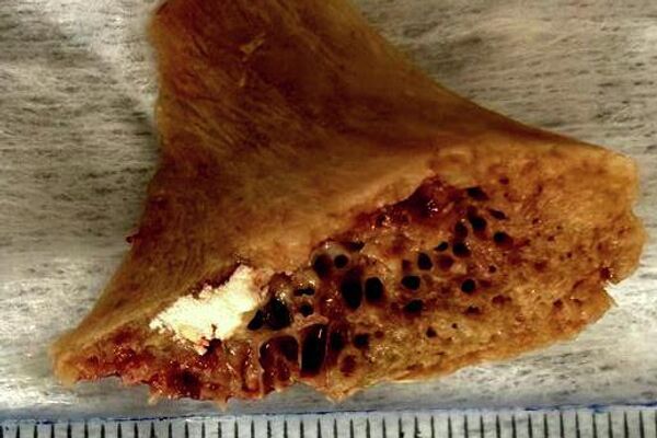 В Бишкеке 15-летний подросток проглотил кость 3,5 × 4 сантиметра, ее достали операционным путем - Sputnik Кыргызстан