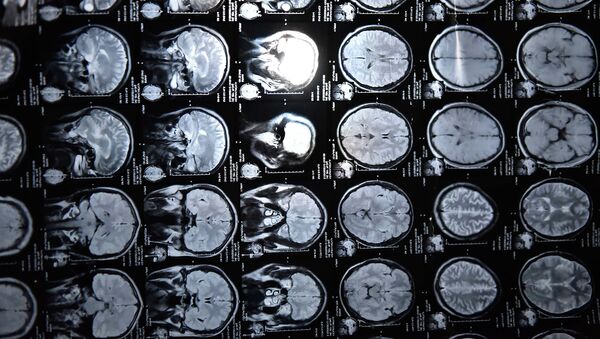 Рентген снимок мозга. Архивное фото - Sputnik Кыргызстан