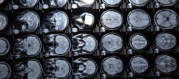 Мээнин рентген сүрөтү. Архив Мээнин рентген сүрөтү. Архив - Sputnik Кыргызстан