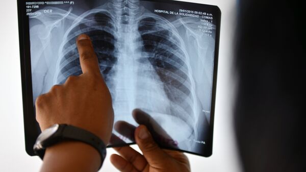 Врач смотрит рентген снимок легких пациента. Архивное фото - Sputnik Кыргызстан