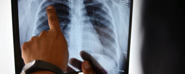 Врач смотрит рентген снимок легкого больного туберкулезом. Архивное фото - Sputnik Кыргызстан