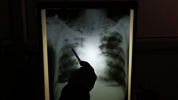 Медициналык кызматкер чыдамкайдын өпкөсүнүн рентген сүрөтүн карап жаткан убакытта. Архив - Sputnik Кыргызстан