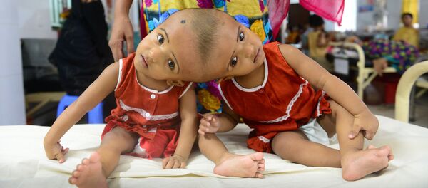 Сиамские близнецы Рабия и Рукия  в Дакке - Sputnik Кыргызстан