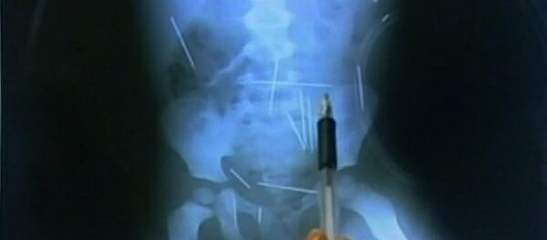 Рентген ребенка, который показывает иголки внутри его тела. Архивное фото - Sputnik Кыргызстан