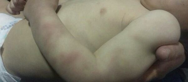 Балыкчы шаарында эки жаштагы наристе ооруканага жаткырылды. Анын денеси менен башында көгала тактар болгон Балыкчы шаарында эки жаштагы наристе ооруканага жаткырылды. Анын денеси менен башында көгала тактар болгон - Sputnik Кыргызстан